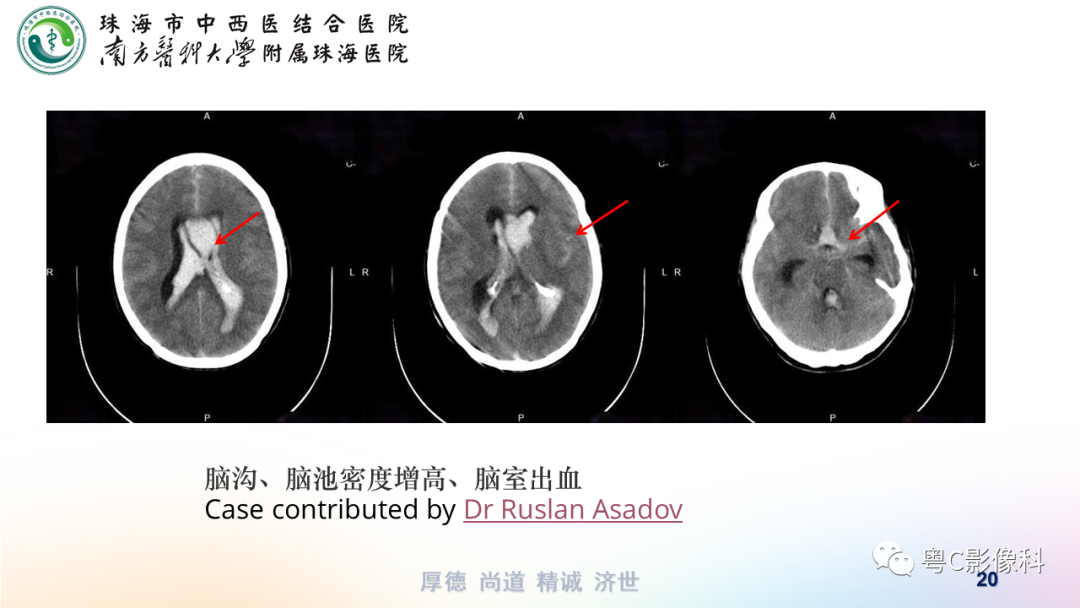 影像PPT - 【PPT】蛛网膜下腔出血-20