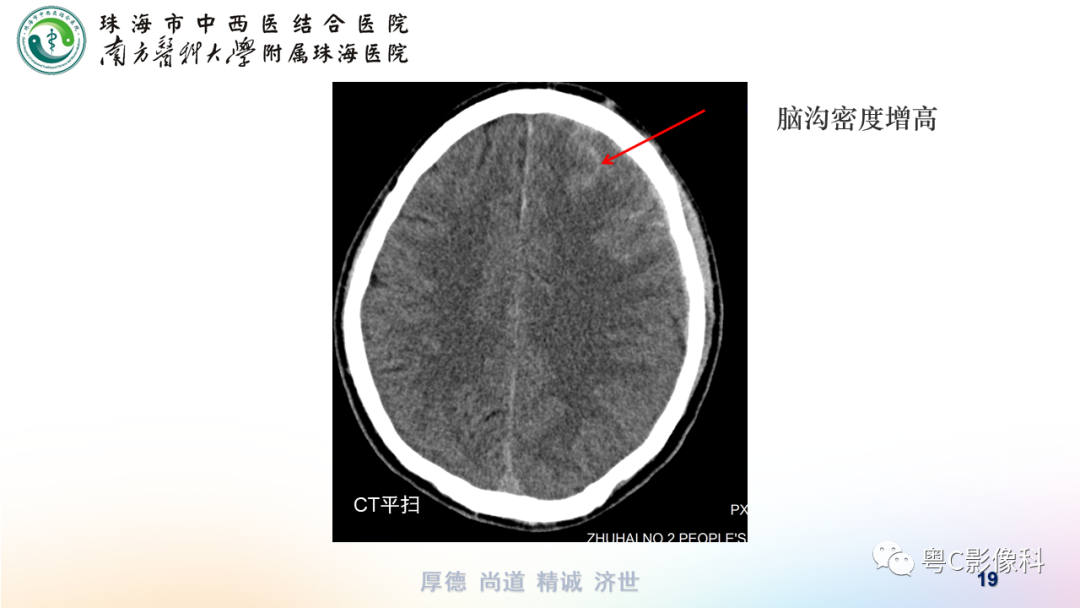 影像PPT - 【PPT】蛛网膜下腔出血-19