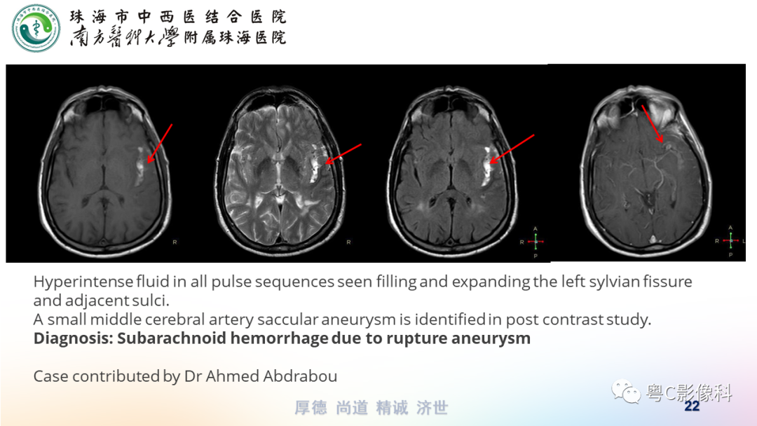 影像PPT - 【PPT】蛛网膜下腔出血-22