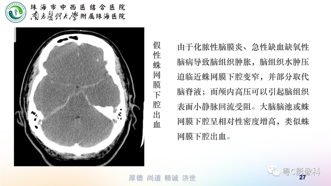 影像PPT - 【PPT】蛛网膜下腔出血-27