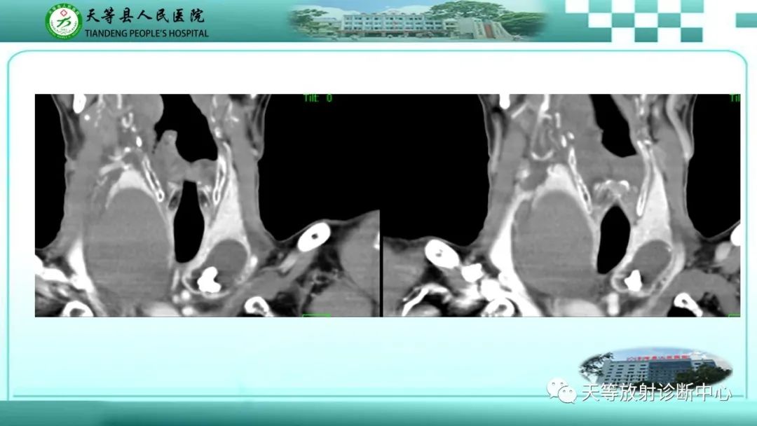 影像PPT - 【PPT】结节性甲状腺肿的CT诊断-8 影像PPT - 【PPT】结节性甲状腺肿的CT诊断-8