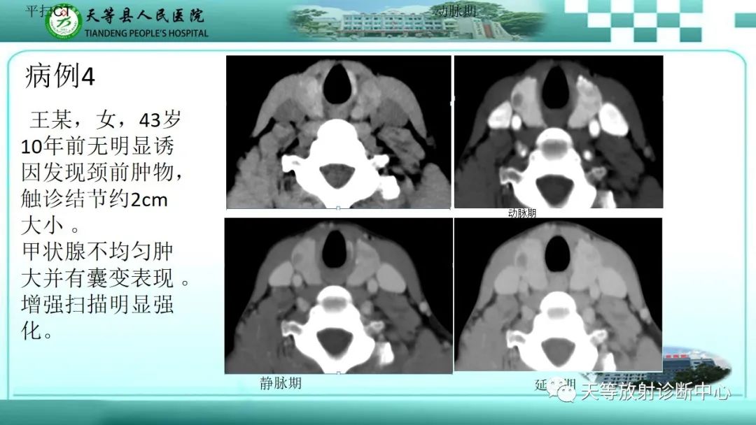 影像PPT - 【PPT】结节性甲状腺肿的CT诊断-14 影像PPT - 【PPT】结节性甲状腺肿的CT诊断-14