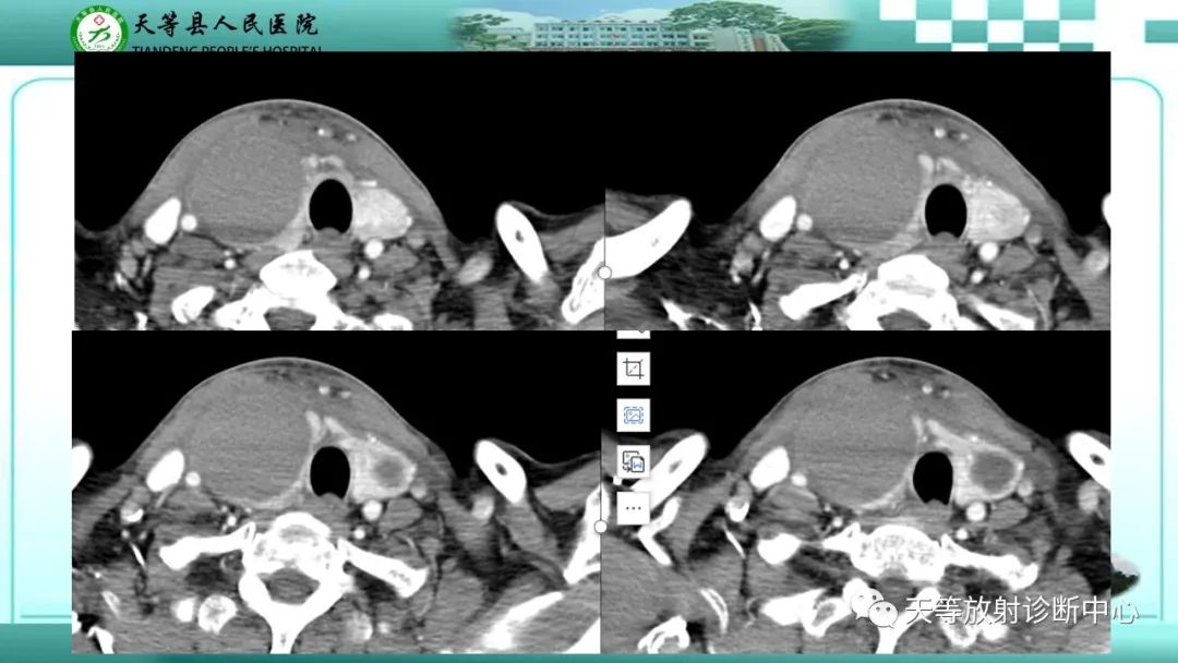 影像PPT - 【PPT】结节性甲状腺肿的CT诊断-4 影像PPT - 【PPT】结节性甲状腺肿的CT诊断-4