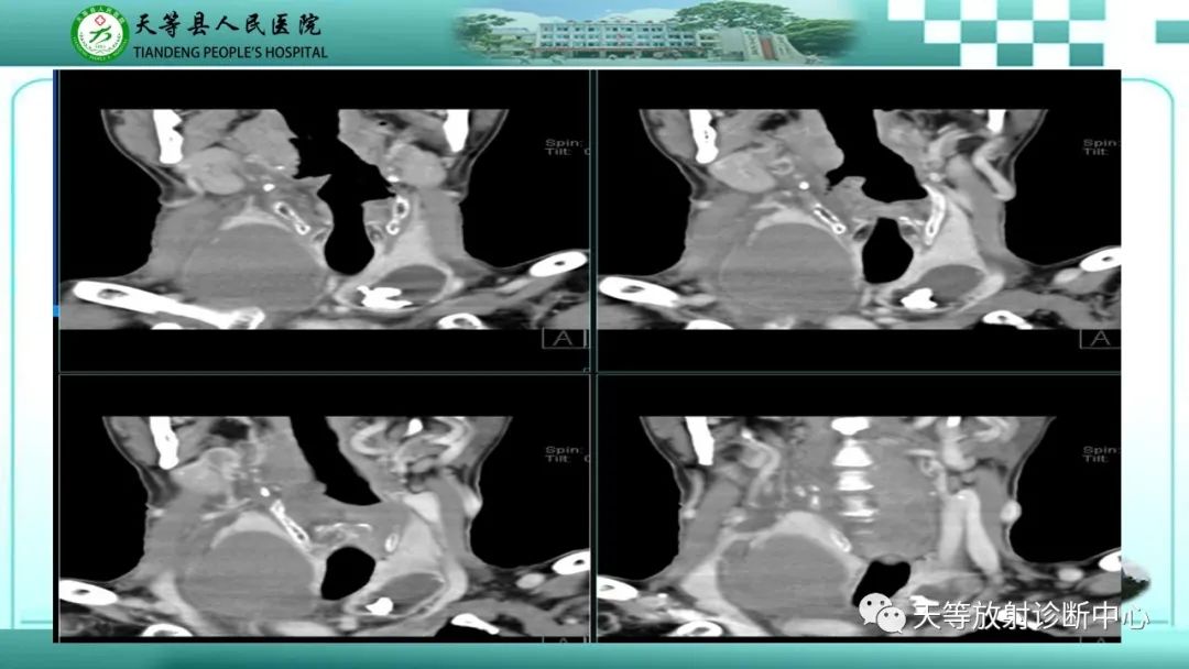 影像PPT - 【PPT】结节性甲状腺肿的CT诊断-9 影像PPT - 【PPT】结节性甲状腺肿的CT诊断-9