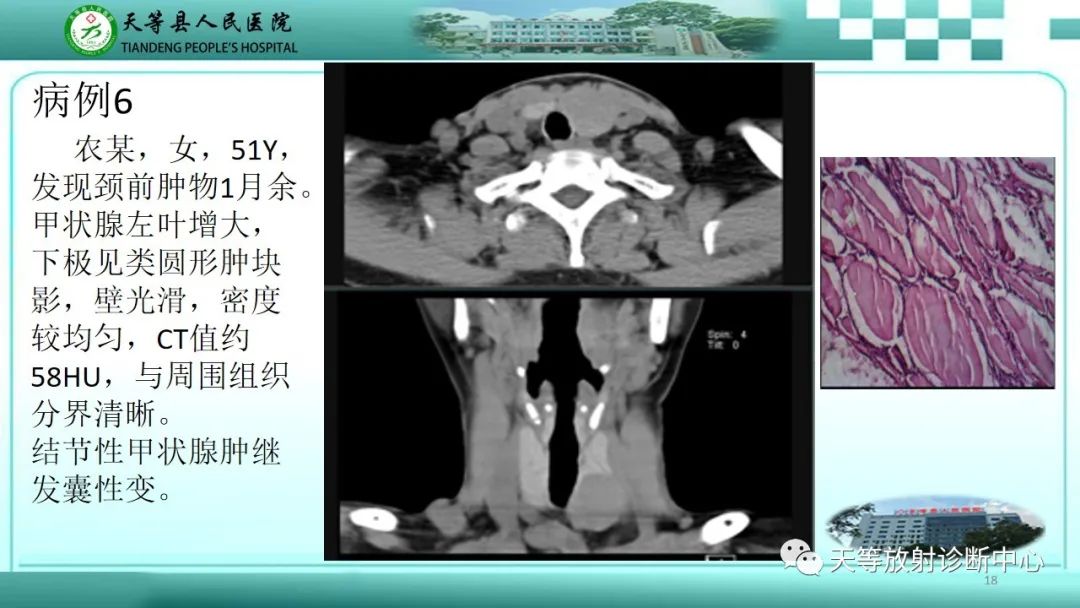 影像PPT - 【PPT】结节性甲状腺肿的CT诊断-16 影像PPT - 【PPT】结节性甲状腺肿的CT诊断-16