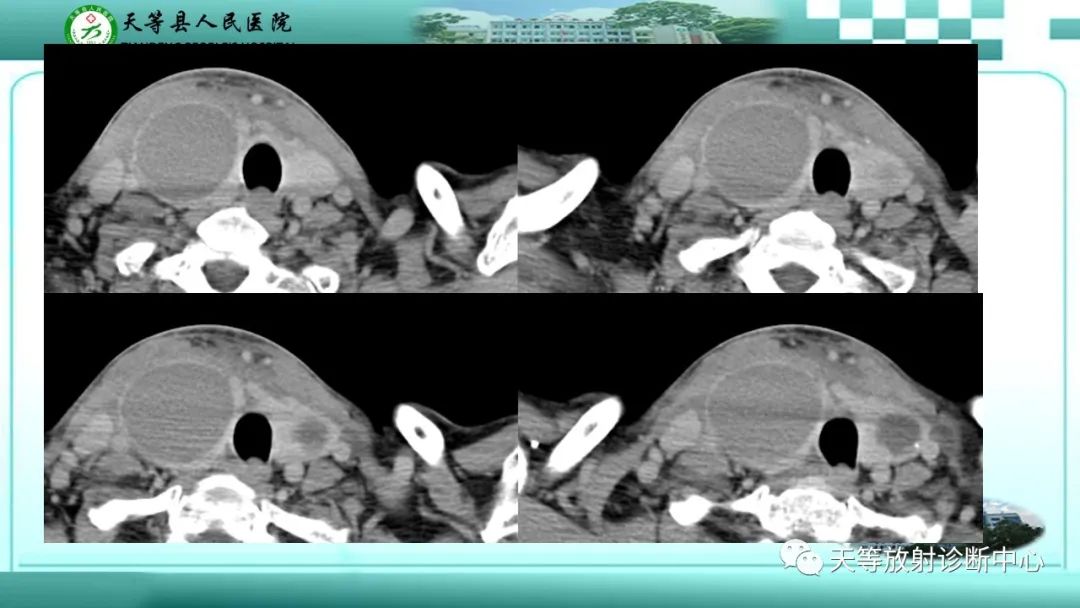 影像PPT - 【PPT】结节性甲状腺肿的CT诊断-6 影像PPT - 【PPT】结节性甲状腺肿的CT诊断-6