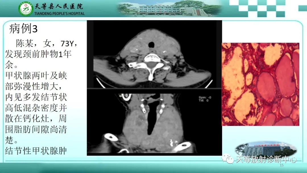 影像PPT - 【PPT】结节性甲状腺肿的CT诊断-13 影像PPT - 【PPT】结节性甲状腺肿的CT诊断-13