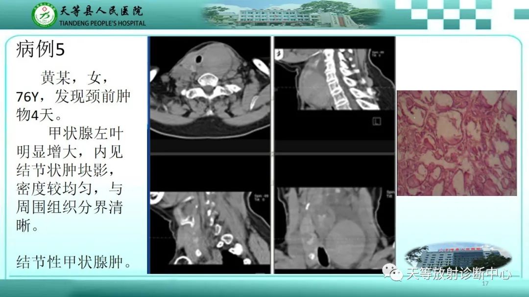 影像PPT - 【PPT】结节性甲状腺肿的CT诊断-15 影像PPT - 【PPT】结节性甲状腺肿的CT诊断-15