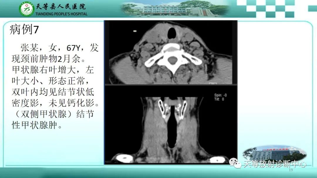影像PPT - 【PPT】结节性甲状腺肿的CT诊断-17 影像PPT - 【PPT】结节性甲状腺肿的CT诊断-17