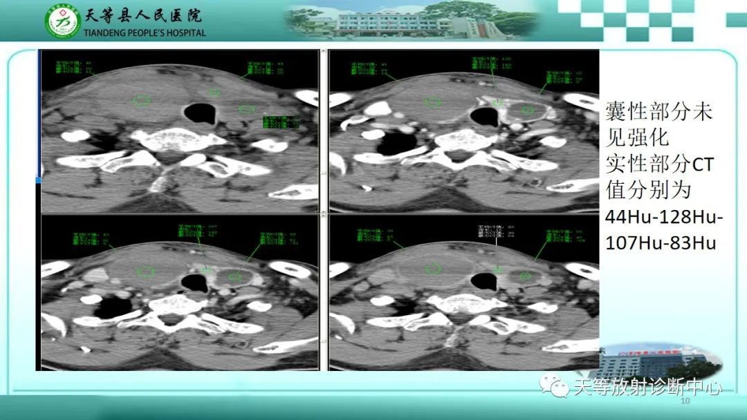 影像PPT - 【PPT】结节性甲状腺肿的CT诊断-10 影像PPT - 【PPT】结节性甲状腺肿的CT诊断-10