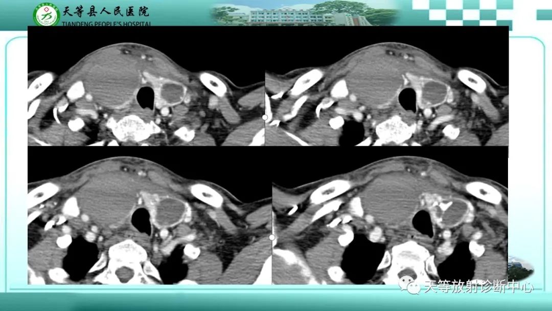 影像PPT - 【PPT】结节性甲状腺肿的CT诊断-5 影像PPT - 【PPT】结节性甲状腺肿的CT诊断-5