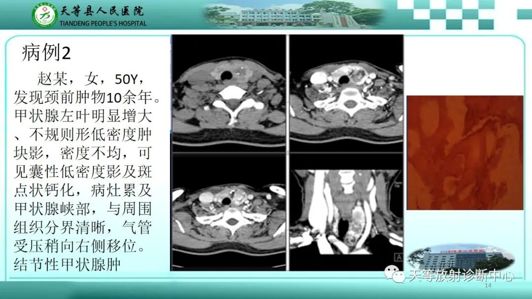 影像PPT - 【PPT】结节性甲状腺肿的CT诊断-12 影像PPT - 【PPT】结节性甲状腺肿的CT诊断-12