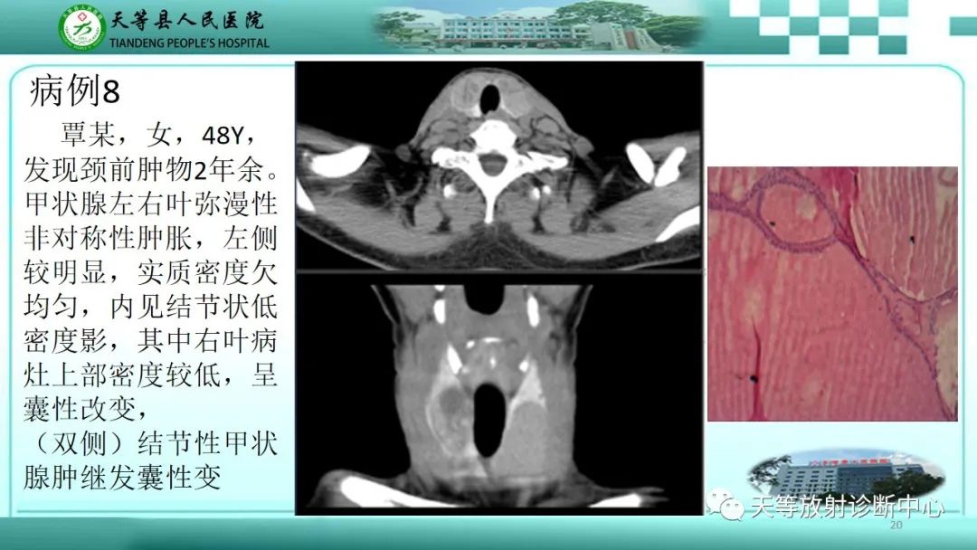 影像PPT - 【PPT】结节性甲状腺肿的CT诊断-18 影像PPT - 【PPT】结节性甲状腺肿的CT诊断-18
