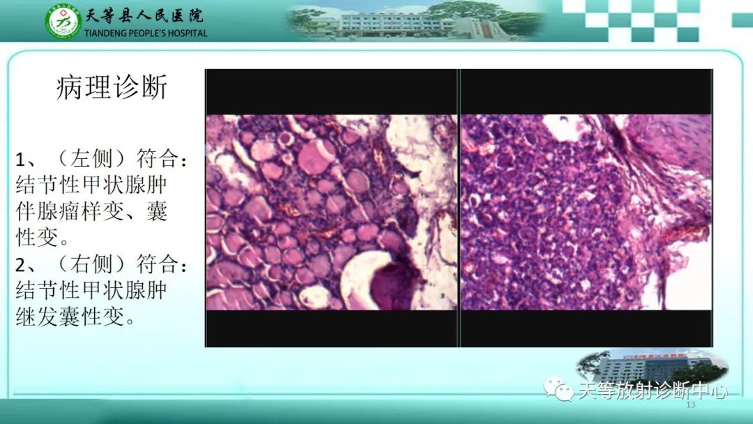 影像PPT - 【PPT】结节性甲状腺肿的CT诊断-11 影像PPT - 【PPT】结节性甲状腺肿的CT诊断-11