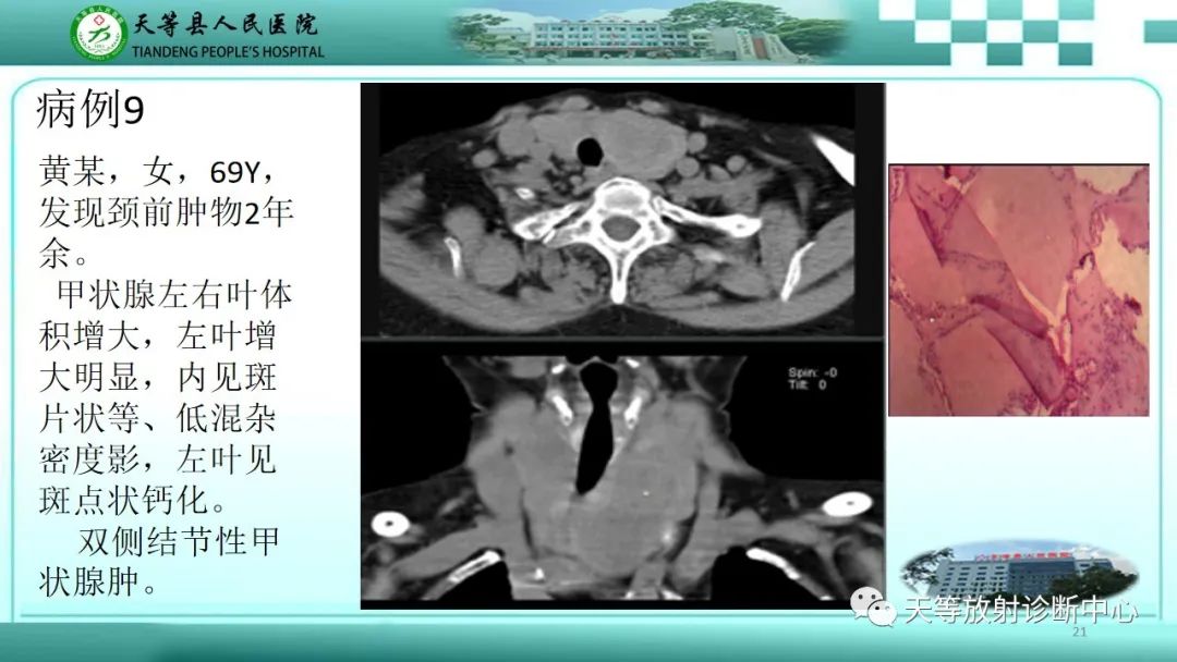 影像PPT - 【PPT】结节性甲状腺肿的CT诊断-19 影像PPT - 【PPT】结节性甲状腺肿的CT诊断-19