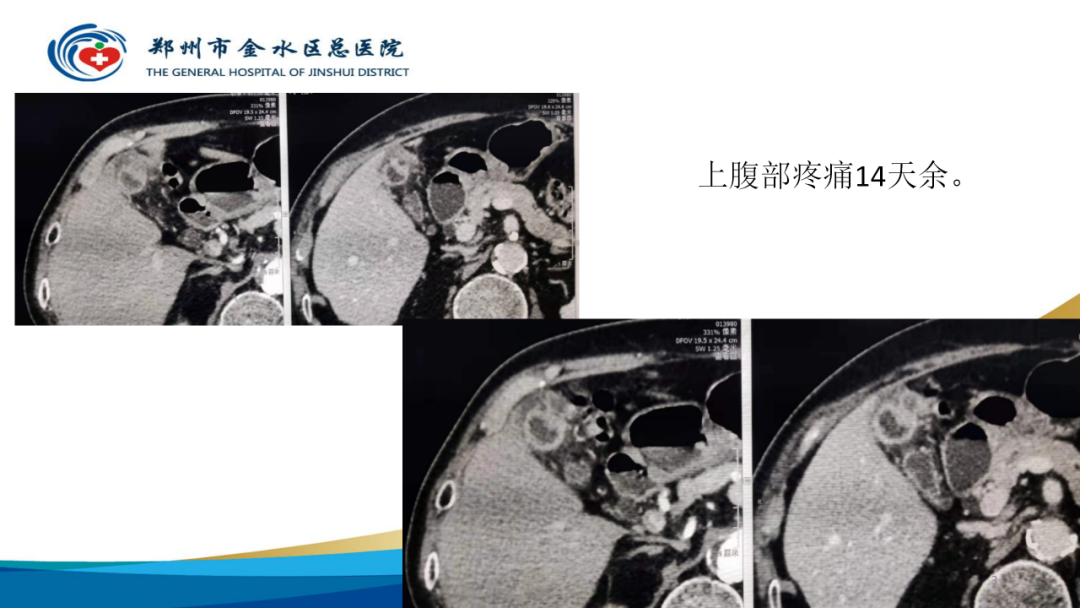 影像PPT - 【PPT】胆囊增厚的常见疾病-3