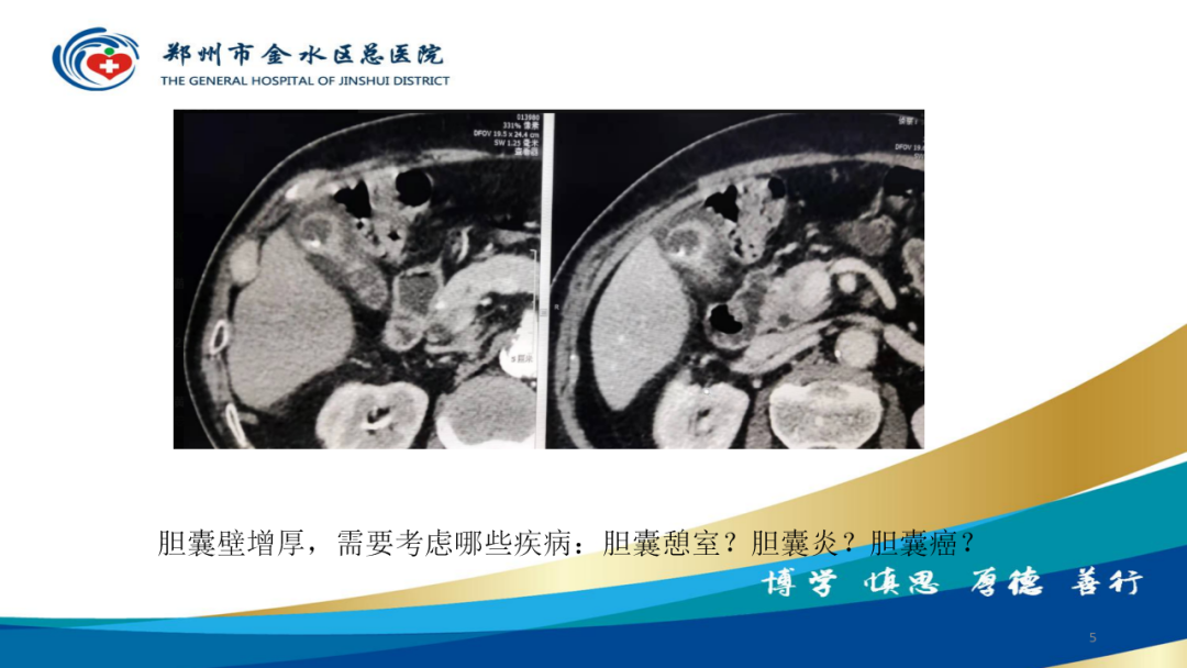 影像PPT - 【PPT】胆囊增厚的常见疾病-5