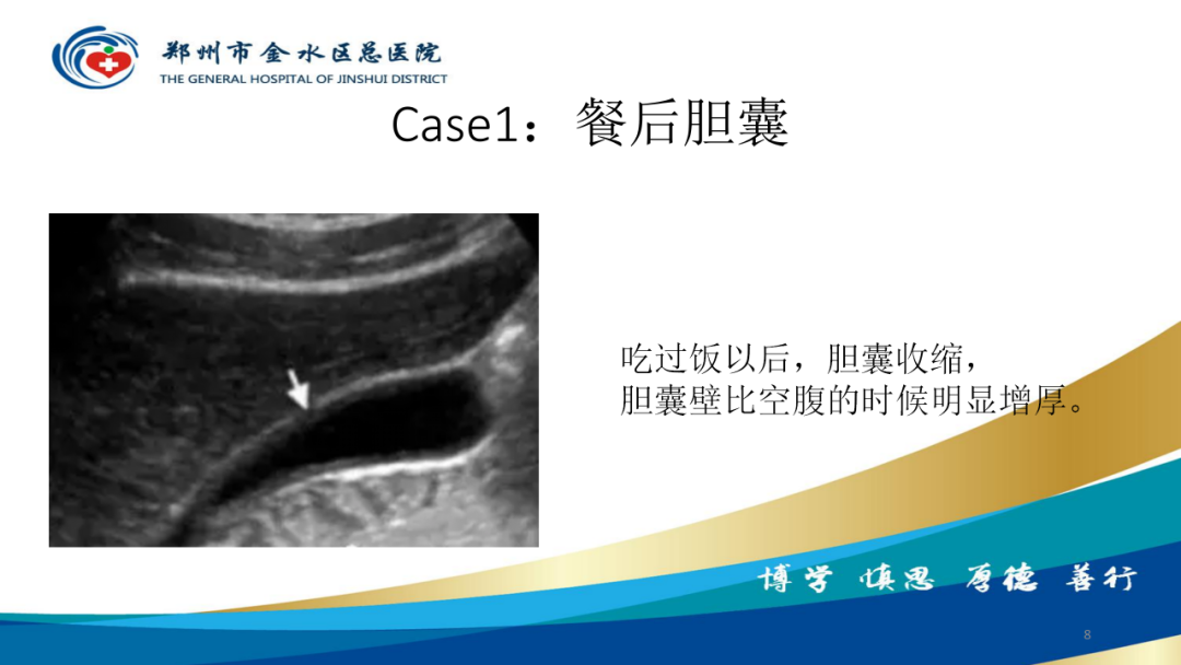 影像PPT - 【PPT】胆囊增厚的常见疾病-8