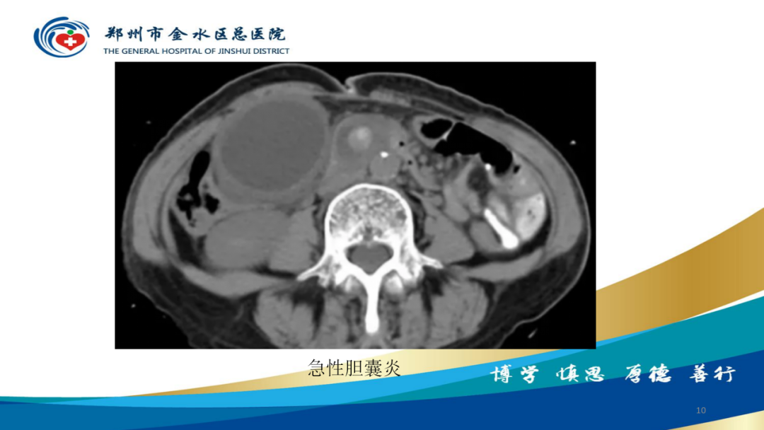影像PPT - 【PPT】胆囊增厚的常见疾病-10
