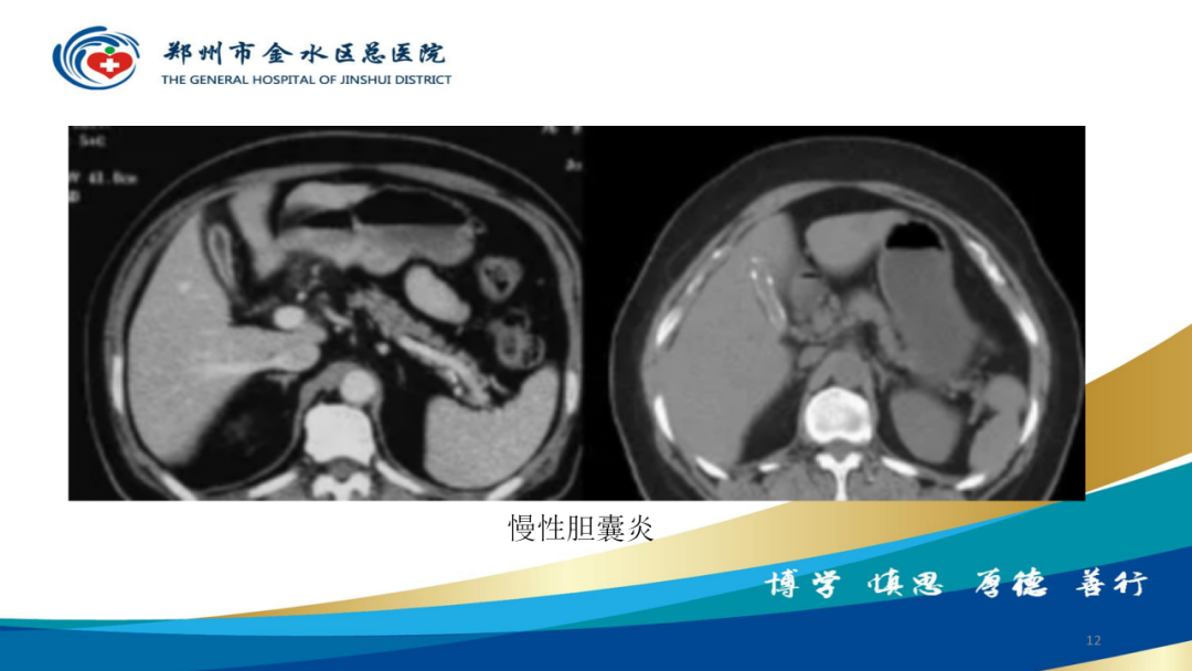 影像PPT - 【PPT】胆囊增厚的常见疾病-12