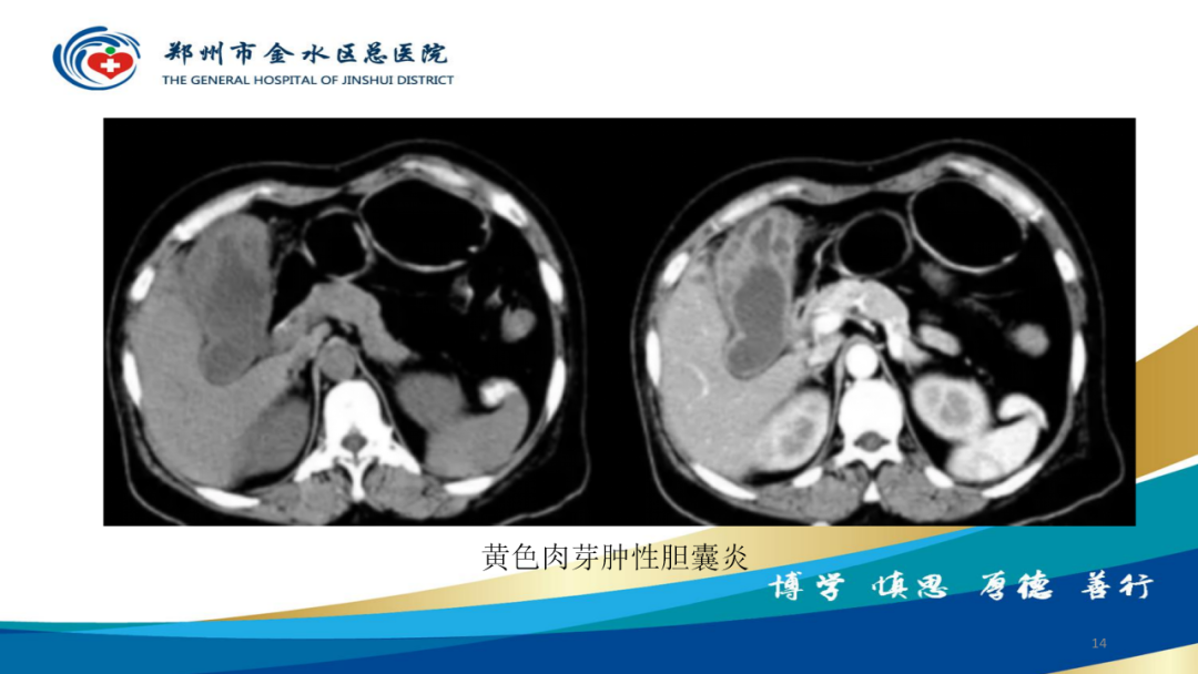 影像PPT - 【PPT】胆囊增厚的常见疾病-14
