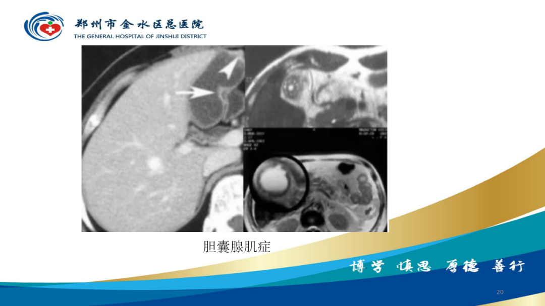 影像PPT - 【PPT】胆囊增厚的常见疾病-20
