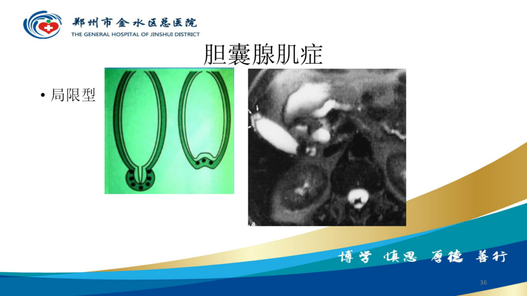 影像PPT - 【PPT】胆囊增厚的常见疾病-36