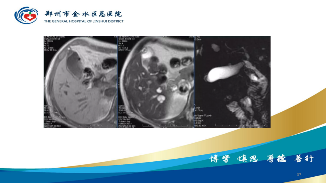 影像PPT - 【PPT】胆囊增厚的常见疾病-37