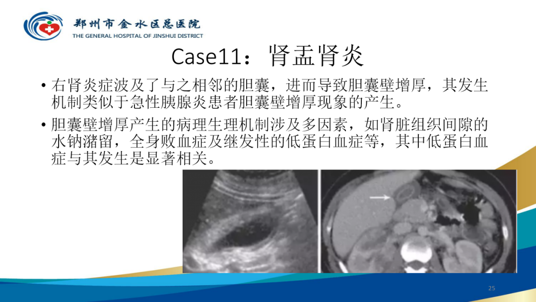 影像PPT - 【PPT】胆囊增厚的常见疾病-25