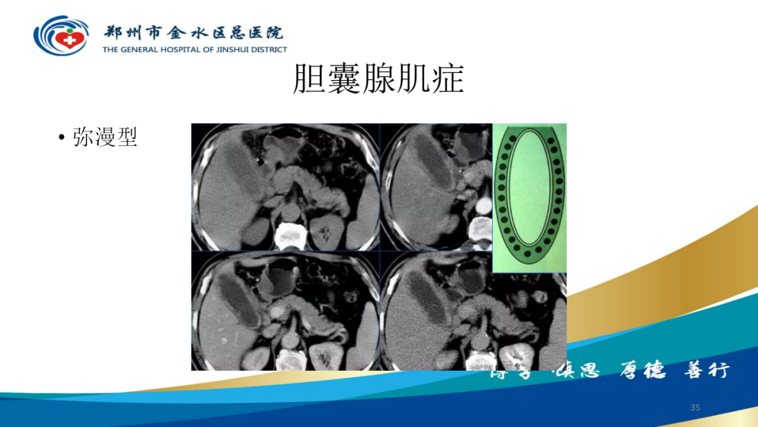 影像PPT - 【PPT】胆囊增厚的常见疾病-35