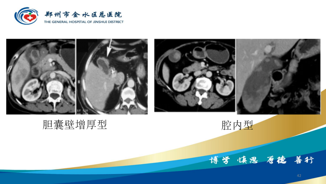 影像PPT - 【PPT】胆囊增厚的常见疾病-42