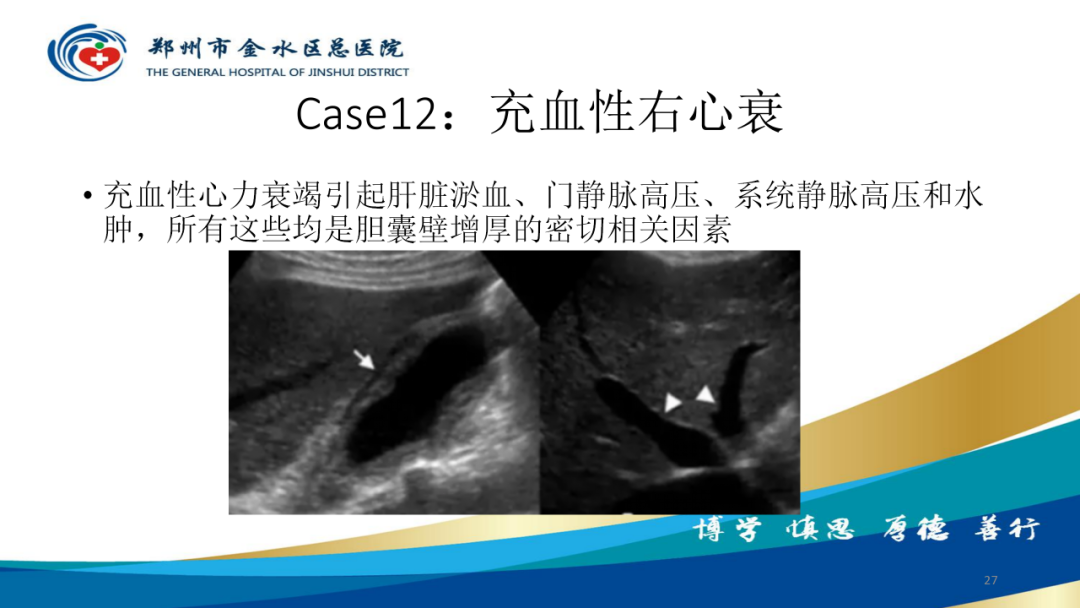 影像PPT - 【PPT】胆囊增厚的常见疾病-27
