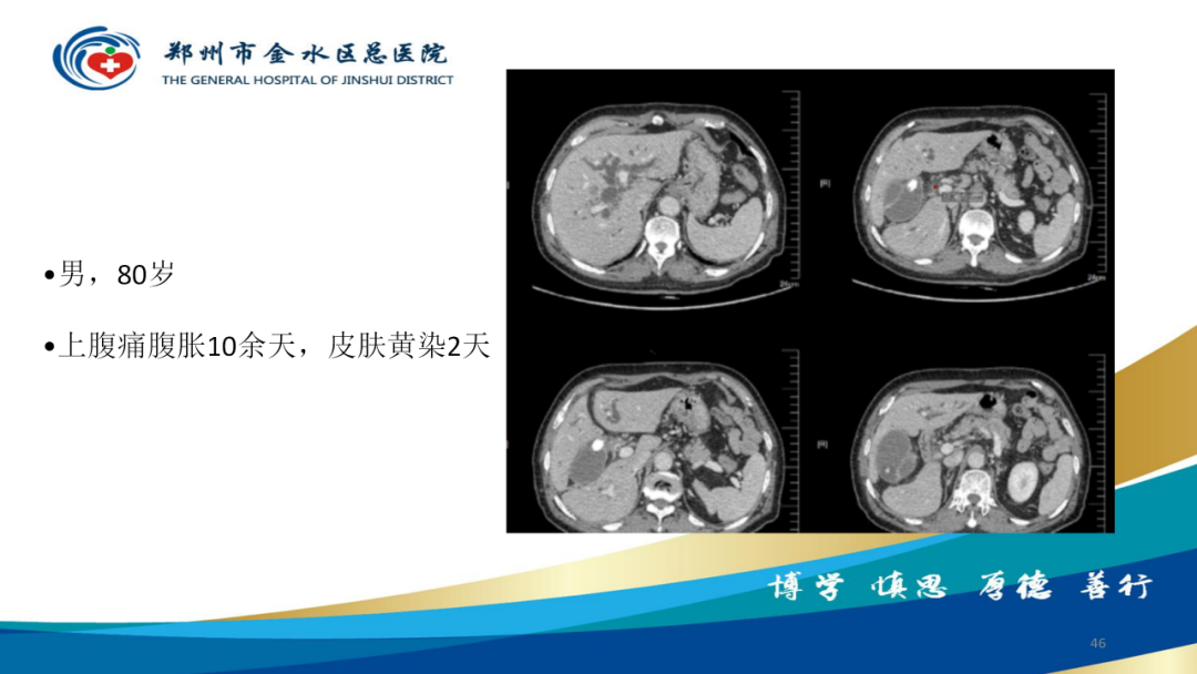 影像PPT - 【PPT】胆囊增厚的常见疾病-46