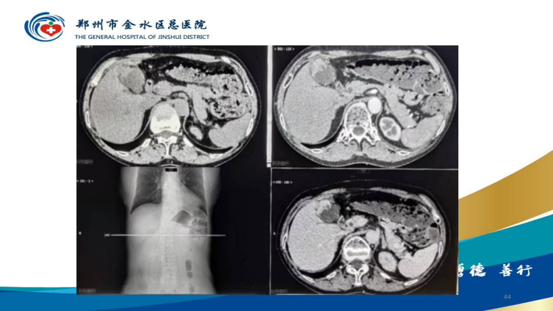 影像PPT - 【PPT】胆囊增厚的常见疾病-44