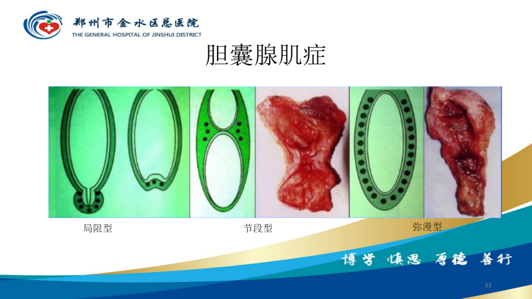 影像PPT - 【PPT】胆囊增厚的常见疾病-33