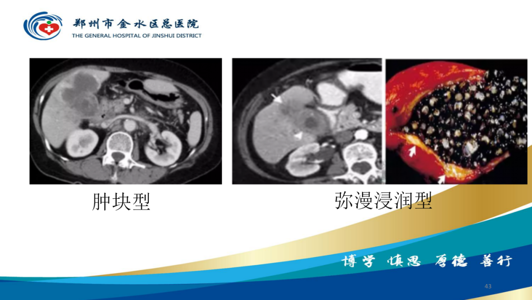 影像PPT - 【PPT】胆囊增厚的常见疾病-43