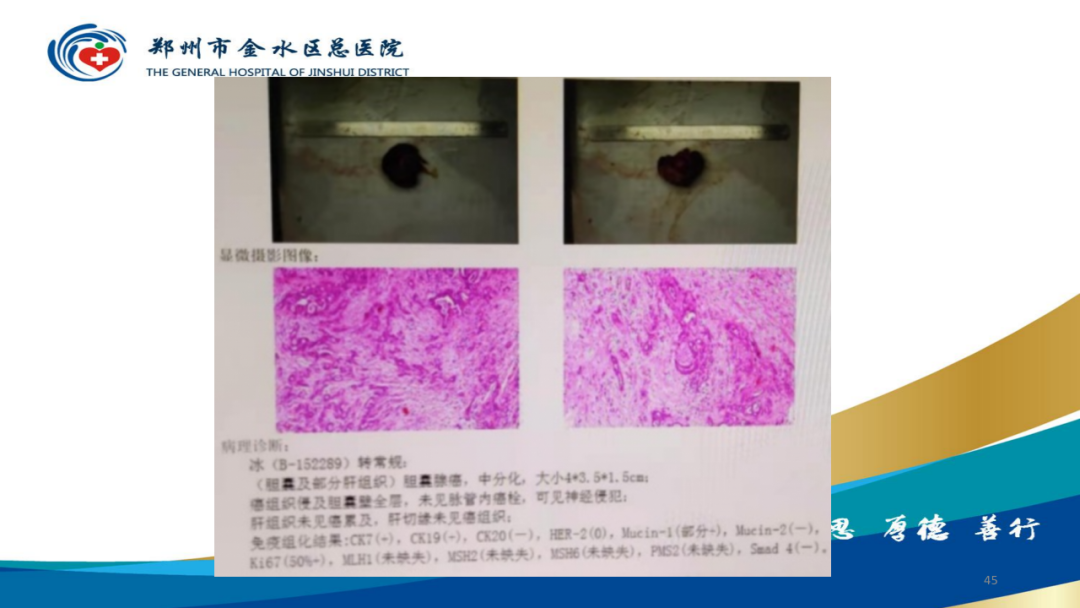 影像PPT - 【PPT】胆囊增厚的常见疾病-45