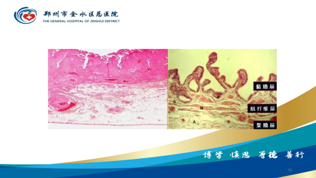 影像PPT - 【PPT】胆囊增厚的常见疾病-31
