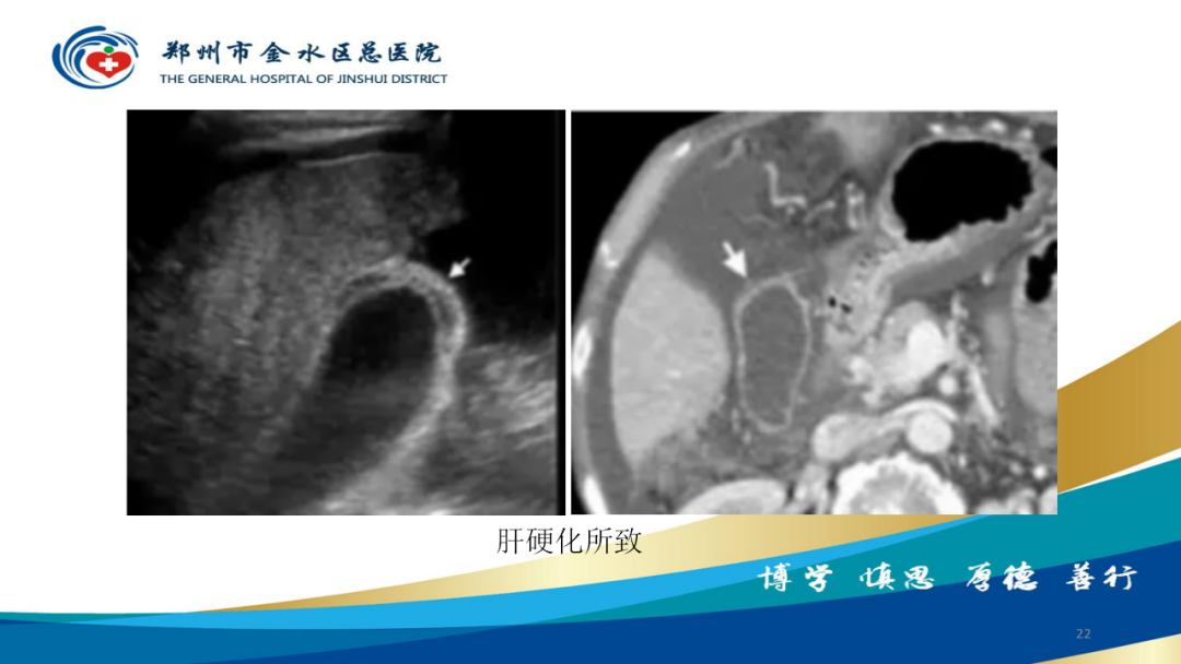 影像PPT - 【PPT】胆囊增厚的常见疾病-22