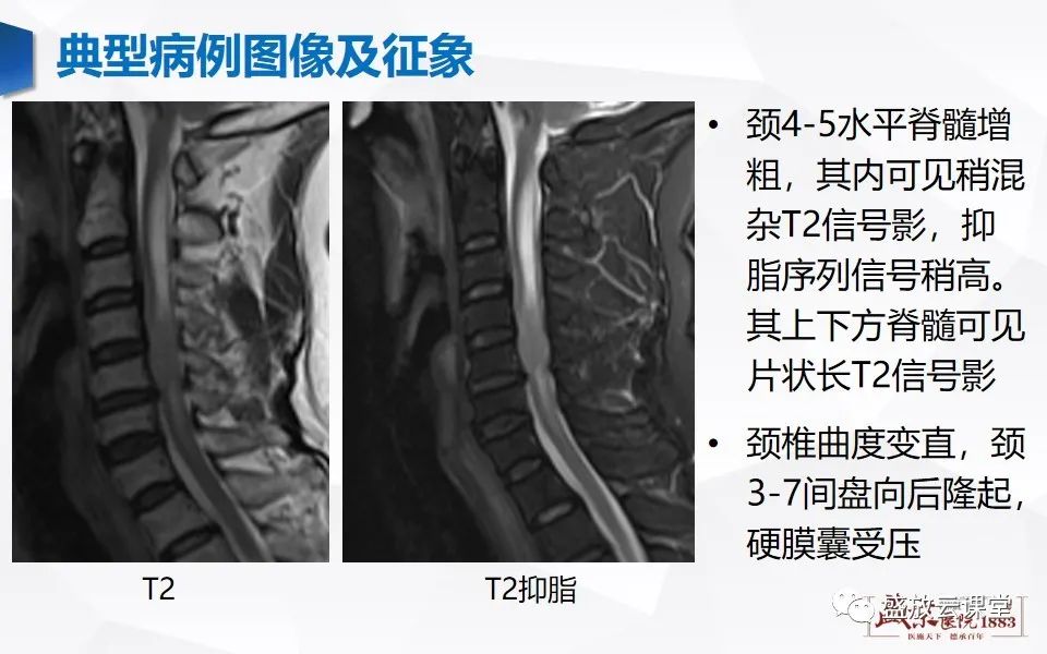 影像PPT - 【PPT】脊髓肿瘤（椎管内肿瘤）-4