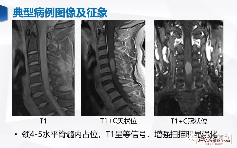 影像PPT - 【PPT】脊髓肿瘤（椎管内肿瘤）-5