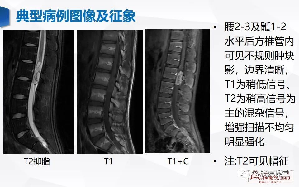影像PPT - 【PPT】脊髓肿瘤（椎管内肿瘤）-10