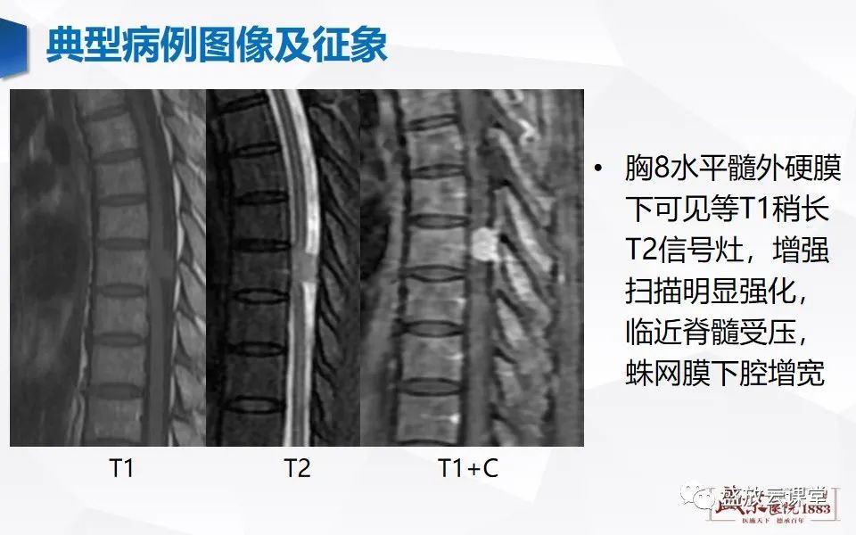 影像PPT - 【PPT】脊髓肿瘤（椎管内肿瘤）-21