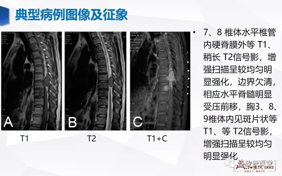 影像PPT - 【PPT】脊髓肿瘤（椎管内肿瘤）-26
