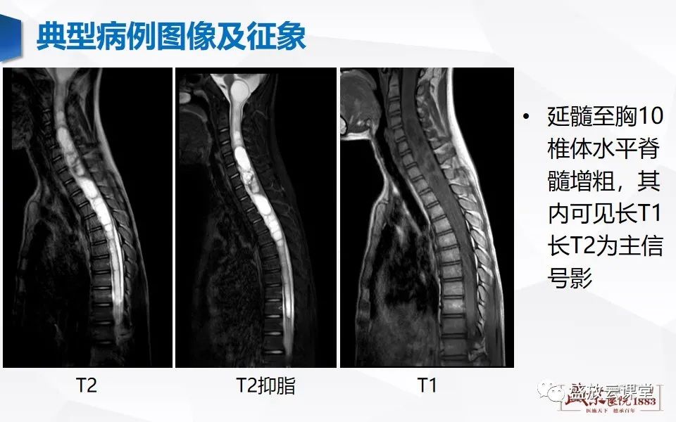影像PPT - 【PPT】脊髓肿瘤（椎管内肿瘤）-15