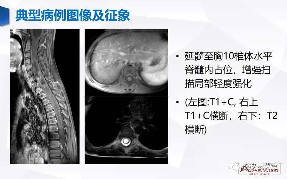 影像PPT - 【PPT】脊髓肿瘤（椎管内肿瘤）-16