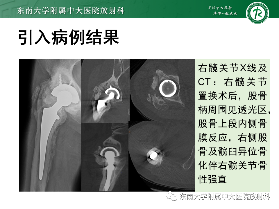 影像PPT - 【PPT】髋关节置换术后影像学评估-3 影像PPT - 【PPT】髋关节置换术后影像学评估-3