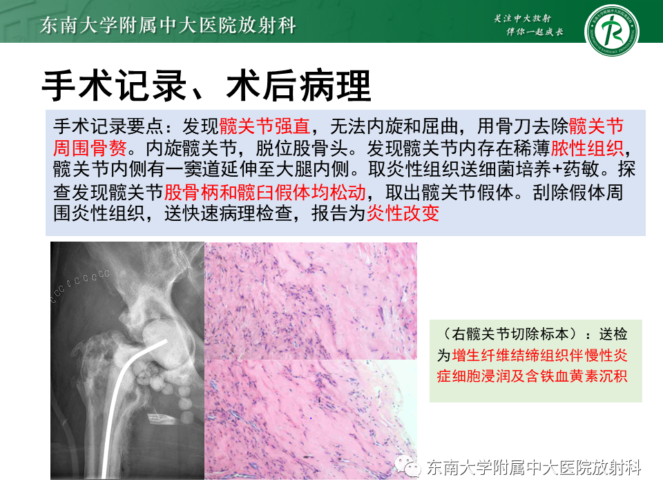 影像PPT - 【PPT】髋关节置换术后影像学评估-4 影像PPT - 【PPT】髋关节置换术后影像学评估-4