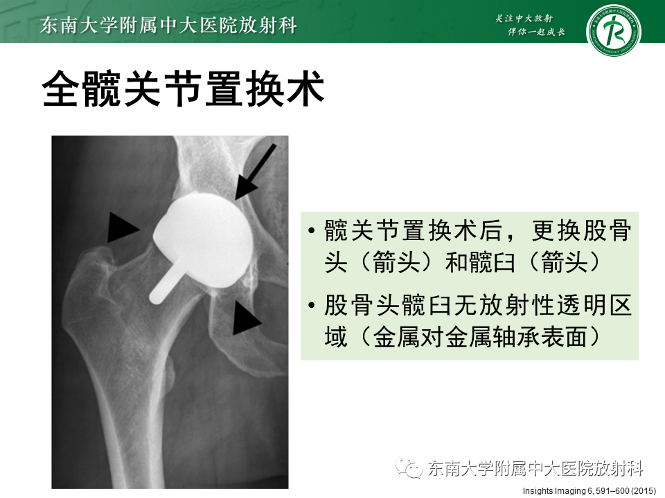 影像PPT - 【PPT】髋关节置换术后影像学评估-9 影像PPT - 【PPT】髋关节置换术后影像学评估-9
