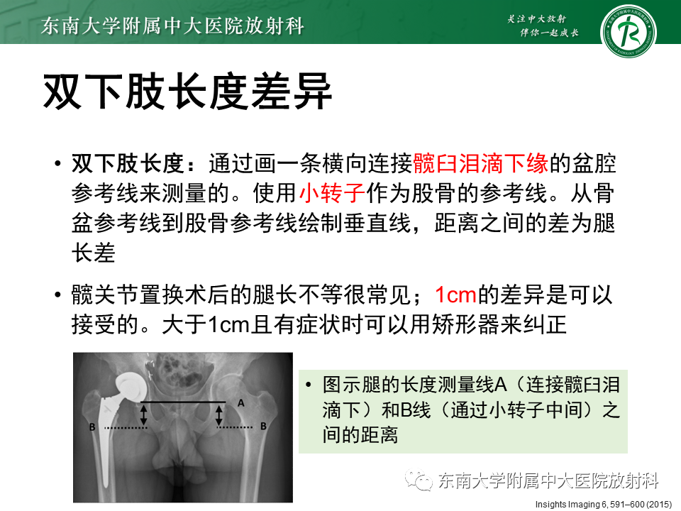 影像PPT - 【PPT】髋关节置换术后影像学评估-12 影像PPT - 【PPT】髋关节置换术后影像学评估-12